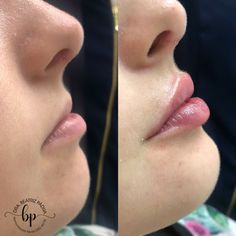 Small Lips With Filler, Lip Filler Examples, Lip Filler Smile Before And After, Flat Lips Filler, Lip Filler Inspo 0.5ml, First Time Lip Fillers, Lip Filler Pouty Lips, Lip Filler Half Syringe, Natural Lip Filler Inspiration