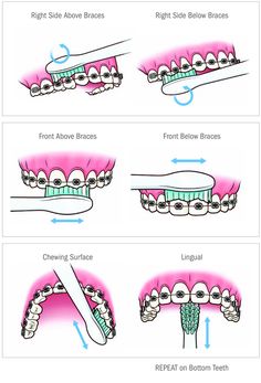 Healthy happy smiles during braces! Learn useful tips here:). Dental Braces Colors, Braces Food, Cute Braces Colors, Braces Tips, Getting Braces, Haut Routine, Cute Braces, Kedokteran Gigi, Brace Face