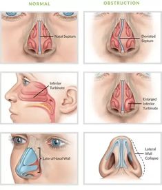 Dr Athira is a best doctor for Nose Examination and Nasal Obstruction treatment in Bangalore. Our hospital provides the best treatment for ENT related problems. Sinus Pressure Relief, Nasal Polyps, Sugar Symptoms, Sinus Health, Congested Nose, Nasal Obstruction