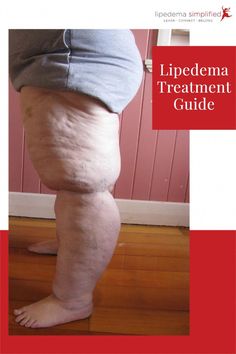 Check out the different lipedema treatments. From Liposuction treatment for lipedema, to compression garments and Lymphedema decongestive therapies and supplements. Lipedema Legs, Lipedema Diet, Fitness Planner Free, Lymph Vessels, Venous Insufficiency, Neck Exercises, Leg Training, Anti Inflammation, Diet Exercise