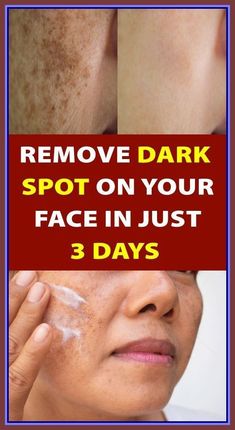 I’m SHOCKED It Removed My Dark Spots In 3 Days, Magic Remedy Natural Botox, Eliminate Wrinkles, Eye Anti Aging, Best Anti Aging, Beauty Skin Care Routine