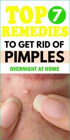 How To Get Rid Of A Blind Pimple U Pimple Remedies Overnight, Pimple Remedies, Face Pimples, Get Rid Of Pimples Overnight, Rid Of Pimples Overnight, Home Remedies For Pimples, Get Rid Of Pimples