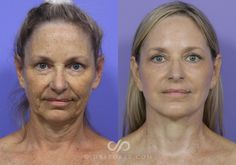 Ponytail Lift, Face Plastic Surgery, Face Rejuvenation, Face Procedures, Skin Improvement, Face Fillers