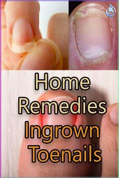 Struggling with ingrown toenails? Discover the best home remedies to relieve pain and promote healing naturally. Learn effective tips and tricks using common household items. Say goodbye to discomfort and hello to healthier feet! Ingrown Toenail Remedy, Ingrown Toenail Remedies, Healing Naturally, Soothing Face Mask, Ingrown Toenail, Ingrown Nail, Back To School Nails, Ingrown Toe Nail, School Nails