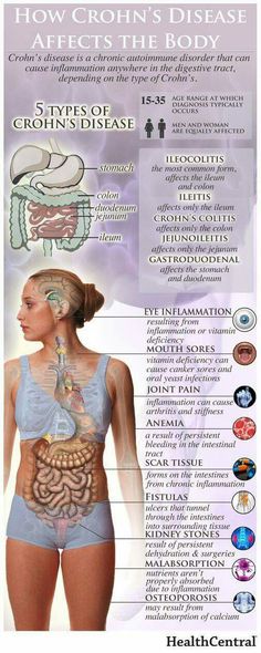 Body Infographic, Crohns Diet, Crohns Awareness, Stomach Problems, Autoimmune Disorder, The Human Body