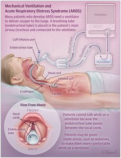 This JAMA Patient Page describes acute respiratory distress syndrome (ARDS) and its risk factors, treatment, and long-term effects. Acute Respiratory Distress, Respiratory Therapy Student, Respiratory Distress, Surgical Nursing, Mechanical Ventilation