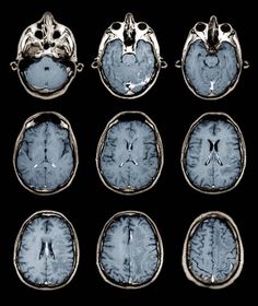 an mri scan shows the different areas of the brain