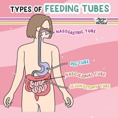 the types of feeding tubes in human body