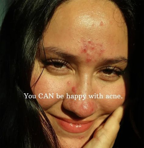 10 beauty influencers who embrace their acne and scars, proving you can feel beautiful just as you are 2 Bad Acne Pictures, Acne Is Beautiful Quotes, Embracing Acne, Acne Is Beautiful, Girls With Acne, Acne Pretty, Acne Aesthetic, Acne Photos, Imperfect Skin