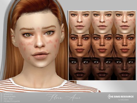 The Sims Resource - Flora Acne Acne Mod Sims 4, Sims 4 Cc Mods Skin, Sims 4 Cc Acne Maxis Match, Sims 4 Facial Presets, Pimples Sims 4 Cc, Sins 4 Skin Details, The Sims 4 Acne Cc, Sims 4 Skin Details Acne, Sims Cc Acne