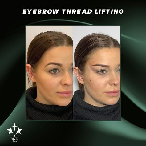 ✨ Lift and define your brows with Eyebrow Thread Lifting at Vivid Clinic! This non-surgical procedure uses fine threads to gently lift and reshape your brows, giving you a youthful, lifted appearance with minimal downtime. 💫 ✅ Non-surgical brow lift for a more defined look ✅ Instant, natural results with minimal recovery ✅ Perfect for creating a more youthful, refreshed appearance 💬 Ready for a brow transformation? Book your free consultation today with Vivid Clinic and achieve the perfect ... Brow Transformation, Botox Before And After, Eyebrow Lift, Thread Lift, Threading Eyebrows, Brow Lift, Free Consultation, Eyebrows, Thread