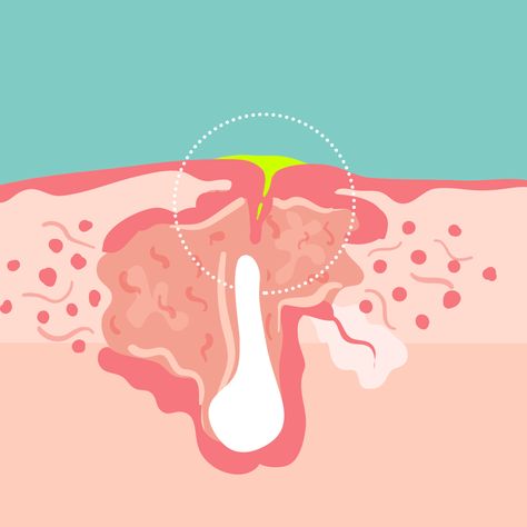 This Is What's Really Coming Out When You Pop Your Pimples+#refinery29 But Acne, Pimple Solution, Beauty Cabin, Pores On Face, Pimples On Forehead, Popping Pimples, Acne Hacks, Herbalife Nutrition Club, Tie A Necktie