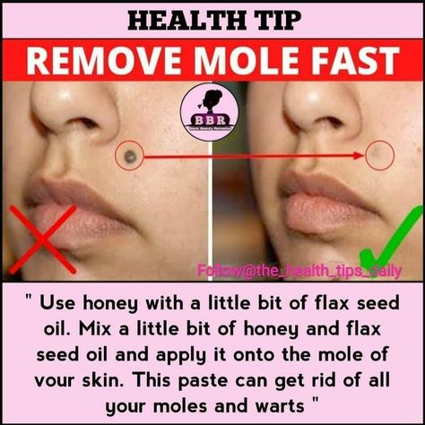 How To Remove Moles Naturally, How To Remove Moles From Face, How To Remove Moles, Remove Moles, Remove Skin Tags Naturally, Skin Moles, Mole Removal, Natural Skin Care Remedies, Natural Face Skin Care