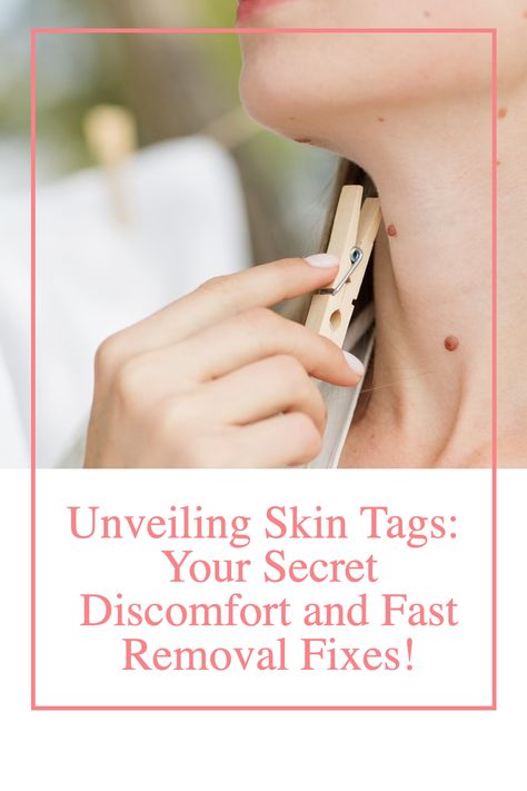 Skin tags, are a very common skin growths that can appear on various parts of the body which includes the neck. While these are usually harmless, many people choose to remove them for cosmetic reasons or to alleviate discomfort. In this comprehensive guide, we’ll explore the causes and symptoms of skin tags, as well as safe and effective methods for their removal, including the use of skin tag removal cream and kits. #Skin #skintags #skincare #beauty #skincaretips Getting Rid Of Skin Tags, Skin Tags Removal Overnight, Skin Tags Removal Overnight How To Get Rid, Skin Tags What Causes, How To Remove Skin Tags, Diy Removal Of Skin Tags, Best Way To Remove Skin Tags, Causes Of Skin Tags, How To Naturally Remove Skin Tags