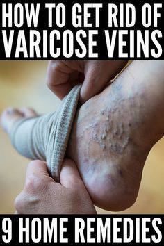 Vericous Veins, Varicose Veins Essential Oils, Varicose Veins Causes, Varicose Vein Removal, Healthy Legs, Varicose Vein Remedy, Leg Veins, Vein Removal, Natural Health Remedies