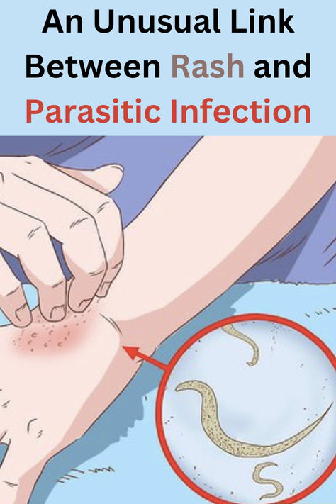 There are three main types of parasites that can affect humans: protozoa, helminths, and ectoparasites. How To Remove Parasites Naturally, Parasites In Humans, Natural Remedies To Remove Parasites, Foods That Naturally Kill Parasites, Symptoms Of Parasites In Humans, Nematodes Parasites, Skin Parasites, Health Facts, Animals Of The World