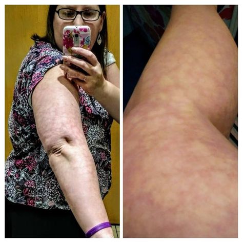 livedo reticularis rash on woman's arm Strep Rash, Rashes On Skin, Leg Discoloration, Heat Rash Remedy, Rash On Hands, Livedo Reticularis, Leg Rash, Ugly Legs, Red Blotchy Skin