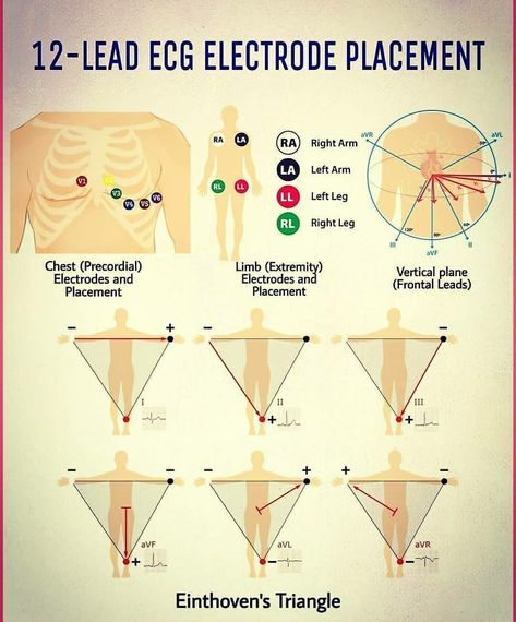 12 - lead ECG Electrode Placement Ekg Lead Placement Cheat Sheets, 12 Lead Ekg Placement Nursing Students, 12 Lead Ekg Cheat Sheet, Ecg Lead Placement, Ekg Placement 12 Lead, 12 Lead Ekg Placement, Ekg Placement, Lead Placement, Medic School