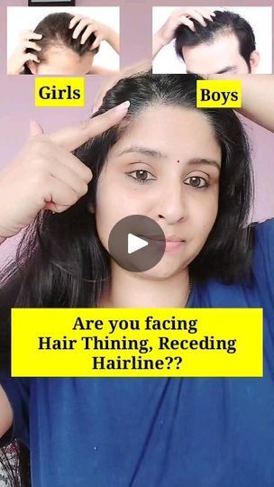 328K views · 9.9K reactions | 🌟Bald patches, thining hairline, big forehead problems then use this home made ginger gel...

Plz do patch test ....
Always use onion juice in dilute form if you are not use to this . this is the safest option to use this....

How I prepare this ✅✅✅
ginger 1 inch
Onion 1/2
Aloe vera gel 1 tsp
Castor oil 1/2 Tsp or Rosemary oil

Benefits ✅ 
Helps in hairregrowth 
Promotes hair growth
Prevents dandruff 
Control hair fall
Prevents scalp infection 

❤Plz focus on healthy diet & keep your scalp clean n healthy and go for this Homeremedies....

❤Use 2 times a week before hairwash....keep it for 1 hr n wash off with mild shampoo....
.
.
Like & Save ❤❤❤
Follow for more @beauty_secrets_with_shalini ❤❤❤
.
.

.
#hairoil #hairoils #hairgrowth #hairgrowthoil #hairgrowthoi Forehead Hair Growth Tips, Forehead Hair Growth, Hair Fall Remedy Home, Hair Fall Remedy, Forehead Hair, Hair Fall Solution, Onion Juice, Bald Patches, Dry Skin Remedies