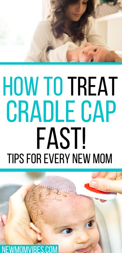 Although cradle cap clears up on its own, you can speed up the process. Use this guide for natural remedies to get rid of your baby's cradle cap. Baby Craddle, Cradle Cap Remedies, Baby Cradle Cap, Baby Remedies, Newborn Tips, Cradle Cap, Pregnancy Hacks, Newborn Baby Tips, Mom Vibes