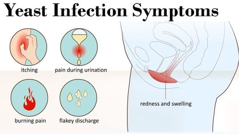 What are the Types of AntiFungal Medicines?  Pharma Health Tips Yeast Infection Pictures, Chronic Yeast Infection, Candida Yeast Infection, Yeast Infection Causes, Yeast Infection Symptoms, Yeast Overgrowth, Candida Cleanse, Candida Overgrowth, Candida Yeast