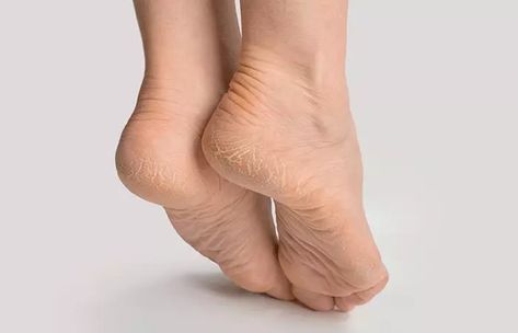 How To Get Rid Of Rough Feet Dry Skin, Crusty Feet Dry Skin, Remove Dry Skin From Feet Heels, Dry Cracked Feet Home Remedy, Dry Peeling Feet Remedy, Cracked Feet Remedies, Best Romantic Images, Cracked Heel Remedies, Dry Heels