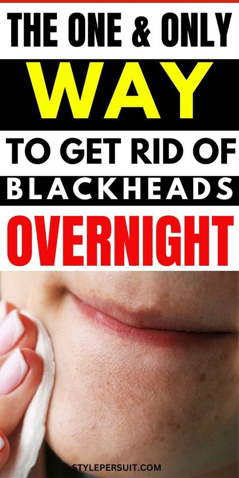 nail problems how to get rid Blackheads On Face, Blackhead Remover Diy, Blackhead Remedies, Blackheads On Nose, Rid Of Blackheads, Blackhead Mask, Face Care Routine, Types Of Acne, Get Rid Of Blackheads