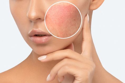 Face Mites are Real. Here's A Skincare Routine to Get Rid of Them. – Truly How To Get Rid Of Mites On Humans, Eye Mites, Mites On Humans, Home Remedies For Face, Demodex Mites, Hydrating Face Wash, Bumpy Skin, Essential Oils For Skin, Face Products