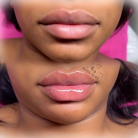 Cute Lip Fillers, Lip Filler Shape Ideas Black Women, Lip Fillers On Black Women, Bratz Doll Lip Filler, Lip Filler Before And After Black Women, Doll Lips Filler, Lip Injections Before And After 1ml, Lip Injections Aesthetic, 1ml Lip Filler Before And After