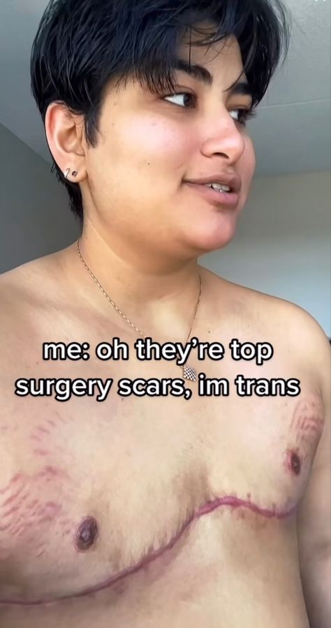 Plus Size Top Surgery, Trans Top Surgery, Trans Top Surgery Tattoos, Top Surgery Art, Trans Man Art, Top Surgery Ftm, Top Surgery Scars, Top Surgery, Therian Stuff