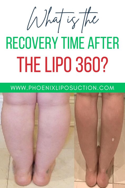 Image by- About Infini Phoenix Liposuction

#liposuction #plasticsurgery #lipo #tummytuck #bbl #cosmeticsurgery #breastaugmentation #plasticsurgeon #mommymakeover #beauty #bodycontouring #rhinoplasty Lipo 360 Recovery Tips, Lipo 360 Before And After, Lipo 360, Lipo Before And After, Fat Transfer, Laser Surgery, Visceral Fat, Mommy Makeover, Patient Experience