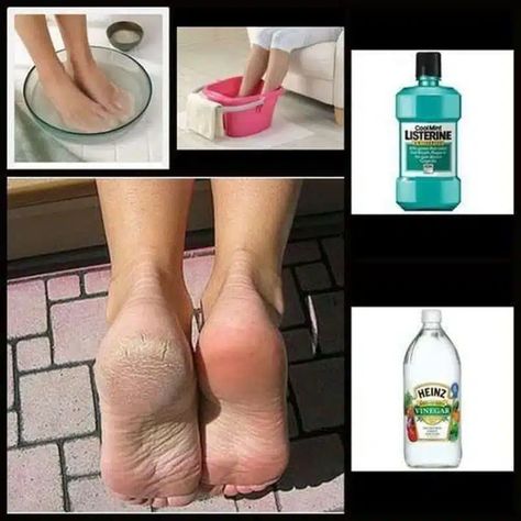 Best DIY Listerine Foot Soak Recipe - Heal Cracked Heels in 30 minutes! - Glossypolish Heal Cracked Heels, Foot Soak Recipe, Antiseptic Mouthwash, Bolesti Chrbta, Foot Soak, Beauty Remedies, Mouthwash, Health And Beauty Tips, Cleaning Products