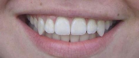 Pointy Canine Teeth Aesthetic, Pointed Canine Teeth Human, Teeth Claim Fangs, Long Canines Teeth Human, Sharp K9 Teeth Human, Natural Sharp Canine Teeth Human, Fang Teeth Natural, Buck Teeth Aesthetic, Smile Claim For Dr