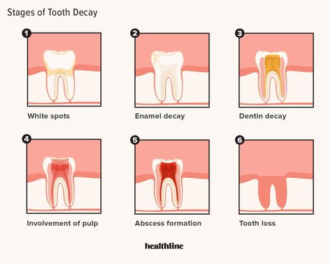 #Rebuild_Tooth_Enamel #Teeth_Decay #Spa_Flyer #Kedokteran_Gigi Stages Of Tooth Decay, Rebuild Tooth Enamel, Teeth Decay, Spa Flyer, Dental Health Care, Kedokteran Gigi, Loose Tooth, Tooth Pain, Tooth Sensitivity