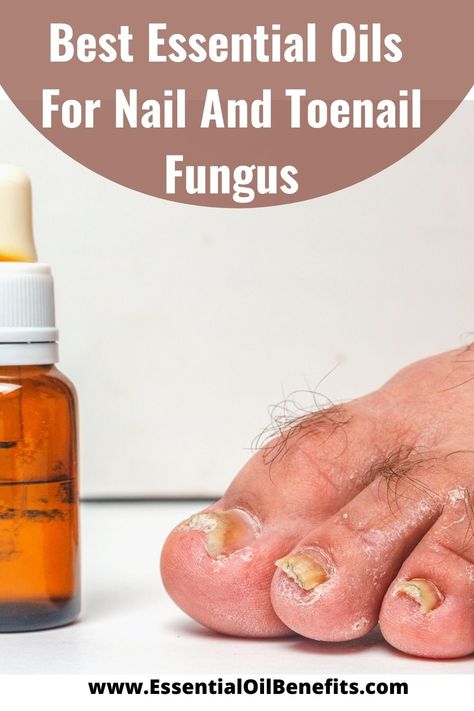 Best Essential Oils For Nail And Toenail Fungus Natural Remedies For Toenail Fungus, Oregano Oil For Toenail Fungus, Nail Fungal Infection Toenails, Anti Fungal Essential Oil, How To Get Rid Of Fungal Toenails, Essential Oils For Nails, Toenail Fungus Essential Oils, Healthy Toenails, Fungi Recipe