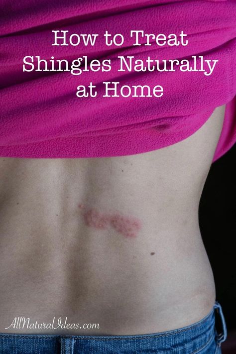 Shingles Remedies, Essential Oils For Shingles, Home Remedies For Rashes, Treating Shingles, Shingles Relief, Home Remedies For Skin, Natural Cough Remedies, Cough Remedies, Natural Health Remedies