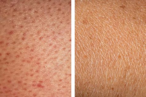 How to Get Rid of Strawberry Legs | Reader's Digest How To Get Rid Of Dots On Legs Skin Care, Flawless Legs Skin, How To Make Legs Look Flawless, Leg Pimples, Red Spots On Legs, Bumps On Legs, Exfoliate Legs, Shaving Bumps, Strawberry Seeds