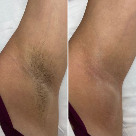 Wax Before After, Waxing Before And After, Body Wax Aesthetic, Waxing Underarms, Waxing Aesthetic, Waxing Armpits, Female Waxing, Wax Business, Waxing Legs