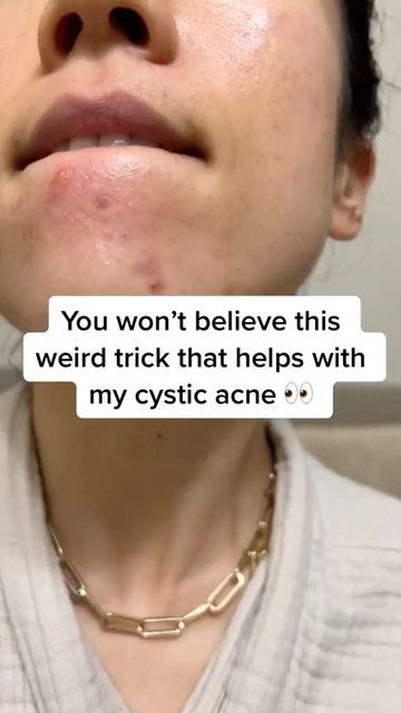 Acne Breakout Remedies, Skincare For Cystic Acne, How To Stop A Breakout, Skin Breakouts Remedies, How To Treat Cystic Acne, How To Get Rid Of Cystic Pimples, How To Clear Acne Overnight, How To Treat Hormonal Acne, How To Get Rid Of Cystic Acne