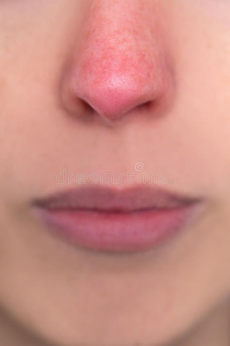 Close up, woman with a red nose, allergy, hypothermia or rosacea. Close up, youn #Sponsored , #SPONSORED, #Paid, #woman, #nose, #rosacea, #red Nose Allergy, Nose Makeup, Newborn Schedule, Red Ball, Red Nose, Allergies, Makeup Inspo, Close Up, Stock Images