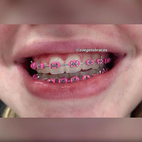 Braces Colors Ideas Cute, Braces Colors Combinations, Braces Ideas, Braces Cute, Pink Braces, Braces Colors Ideas, Braces And Glasses, Braces Smile, After Braces