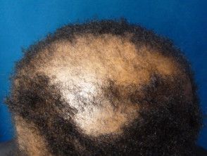 Scarring Alopecia, Hooded Dryer, Tight Braids, Scarring, Fungal Infection, Skin Diseases, Hair Breakage, Hair Follicle, Medical Conditions