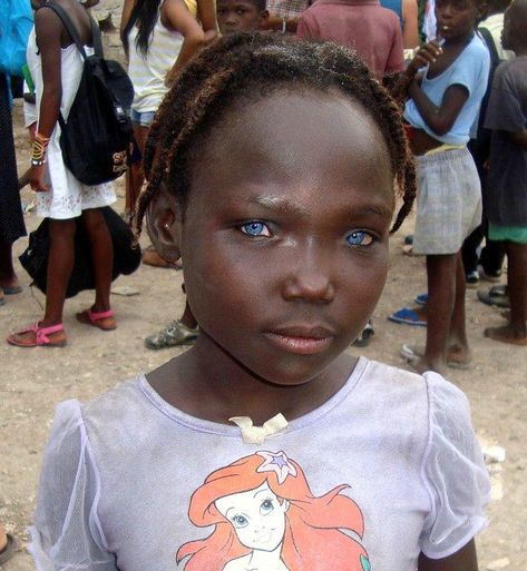 Waardenburg Syndrome - a person with this syndrome will also normally have a nose that looks like a ski slope, with no dip or bump.  Often the upper lip is missing the cupid's bow. Black With Blue Eyes, Girl With Blue Eyes, People With Blue Eyes, Beautiful Blue Eyes, People Of The World, African Beauty, Pretty Eyes, Genetic, Black Is Beautiful