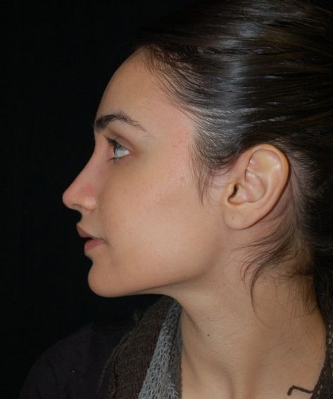 Case 86 Rhinoplasty Before and After Photos - Board Certified Plastic Surgeon Beverly Hills CA Closed Rhinoplasty, Face Plastic Surgery, Nose Fillers, Rhinoplasty Before And After, Job Inspiration, Straight Nose, Perfect Nose, Celebrity Plastic Surgery, Nose Job