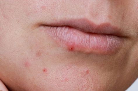 How To Get Rid of Lip Pimples – Cleveland Clinic Pimples Around Lips, Pimples On Lip Line, Hydrogen Peroxide Acne, Rash Care, Lip Pimple, How To Get Rid Of Pimples, Lower Lip, Exfoliating Cleanser, Get Rid Of Blackheads