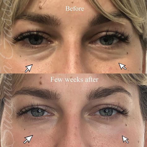 Suzanna Gasso, ACNP-BC, MSN’s Instagram photo: “Tear trough procedure with dermal fillers for these beautiful eyes. The results few weeks later. We get rid of tired look, bags, darkness,…” Tired Look, Tear Trough, Dermal Fillers, Beautiful Eyes, Instagram Photo, Instagram