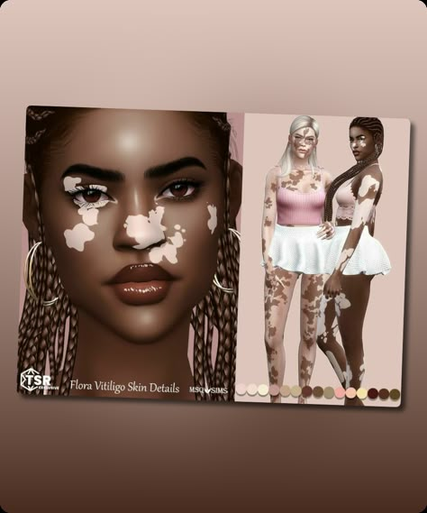 Sims 4 Skins / Skindetail CC: Flora Vitiligo Skin Details By Msqsims Sims Body Overlay Cc, Sims 4 Cc Vitíligo Skin, Sims 4 Vitíligo Skin Cc, Sims 4 Vitíligo Cc, Sims 4 Skins, Sims Skins, Sims 4 Cc Download, Skin Details, Sims 4 Cc Skin