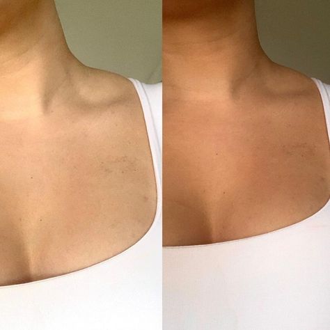 H E L I O U X | MAUI BABE NL on Instagram: “Before & after results of our self tan mousse in medium shade 💫 The hydrating formula makes it so easy to blend into the skin, especially…” Tan Before And After, Tanning Goals, Spray Tan Marketing, Maui Babe, Tanning Mitt, Tanning Mousse, Self Tan, Self Tanning, Perfect Tan