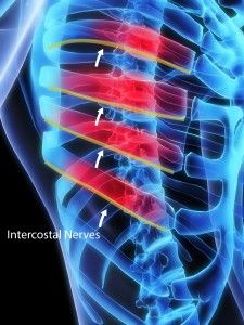 INTERCOSTAL NERVE BLOCK-is a highly specialized procedure used to treat pain in the chest and upper abdomen. Intercostal Neuralgia, Rib Pain, Severe Back Pain, Broken Ribs, Chronic Pain Relief, Pinched Nerve, Nursing School Studying, Alternative Therapies, Nerve Pain