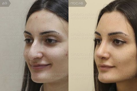 Nose Job Inspiration Natural, Kpop Plastic Surgery, Books Summary, Jaw Reduction Surgery, Nose Surgery Rhinoplasty, V Line Surgery, Nose Fillers, Plastic Surgery Fail, Korean Plastic Surgery